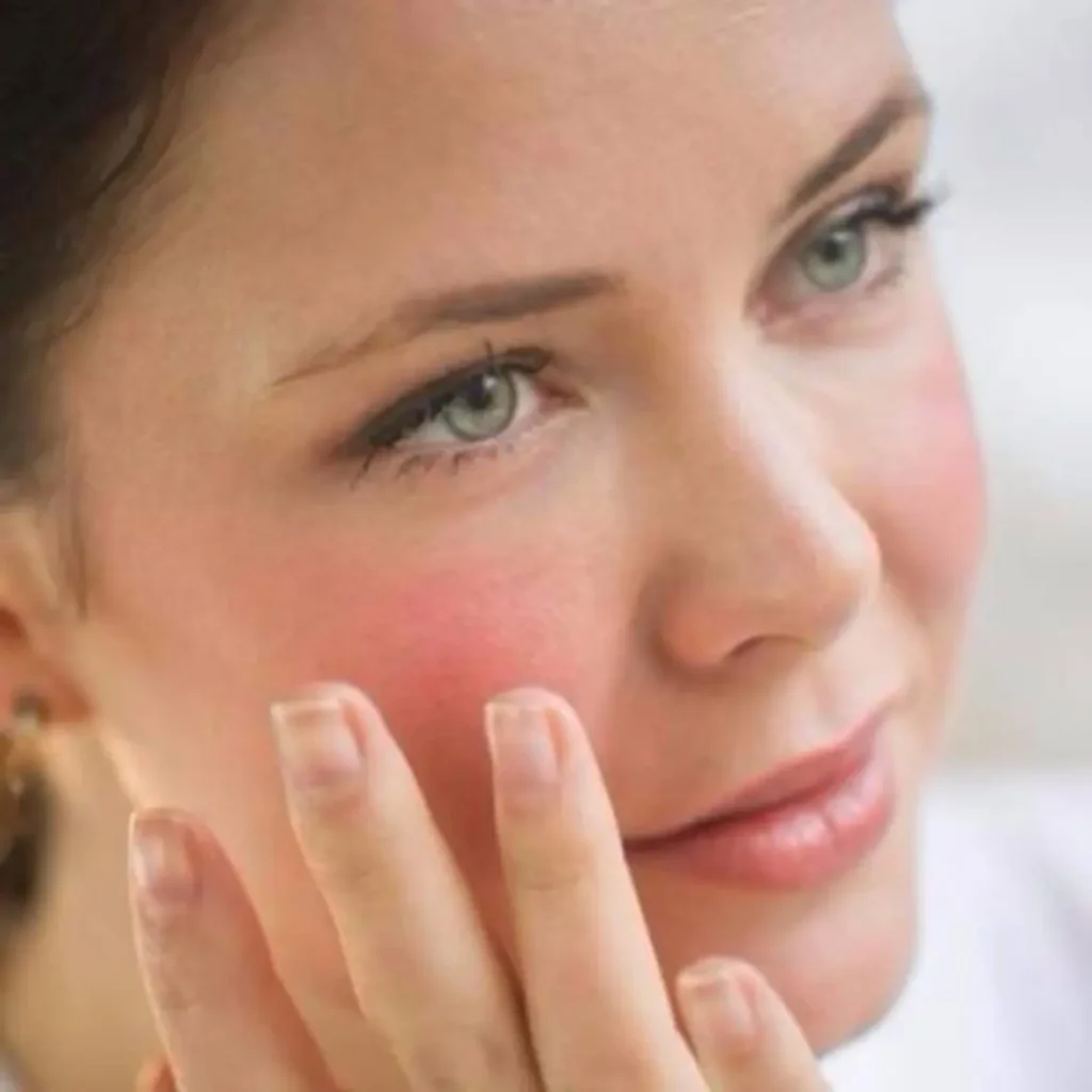 Cómo eliminar las rojeces en la piel