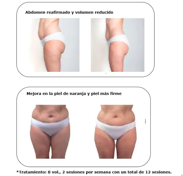 antes-y-después-Fototerapia-Dinámica-Corporal