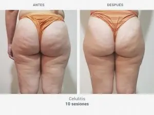 antes-después-rollaction
